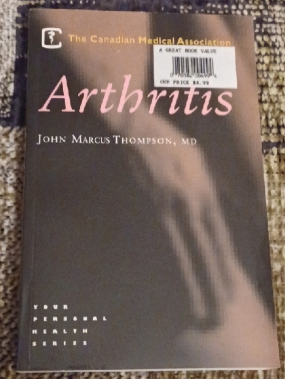 $4 Add-on Arthritis by John Marcus Thompson, MD - Paperback